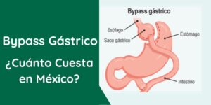 Cuánto cuesta un bypass Gástrico en México
